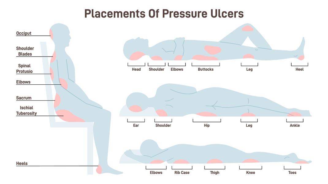 pressure ulcer chart